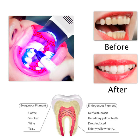 Lámpara Aceleradora De Blanqueamiento Dental De Pedestal